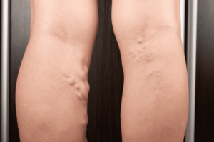 Deep Vein Thrombosis treatment in camp spring