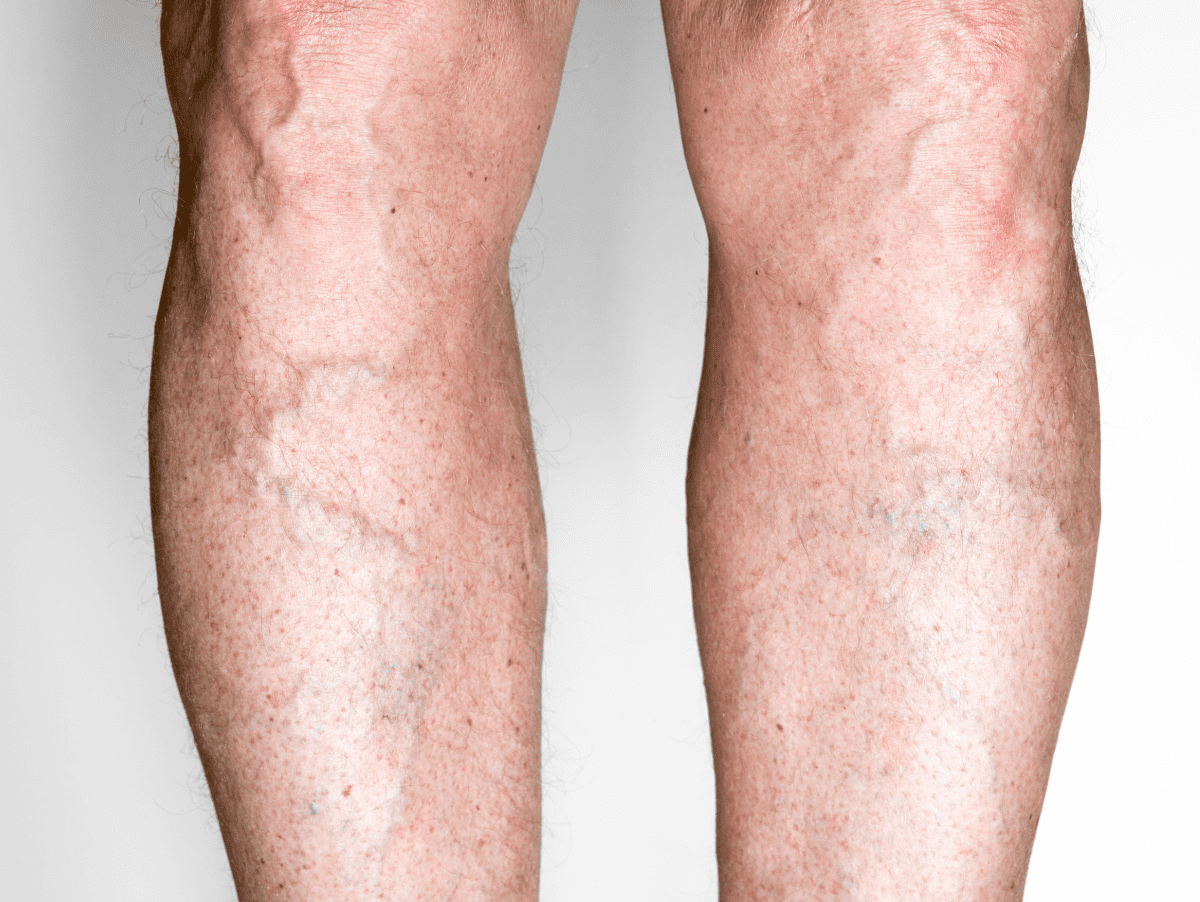 Varicose vein treatment in Waldorf & Camp spring