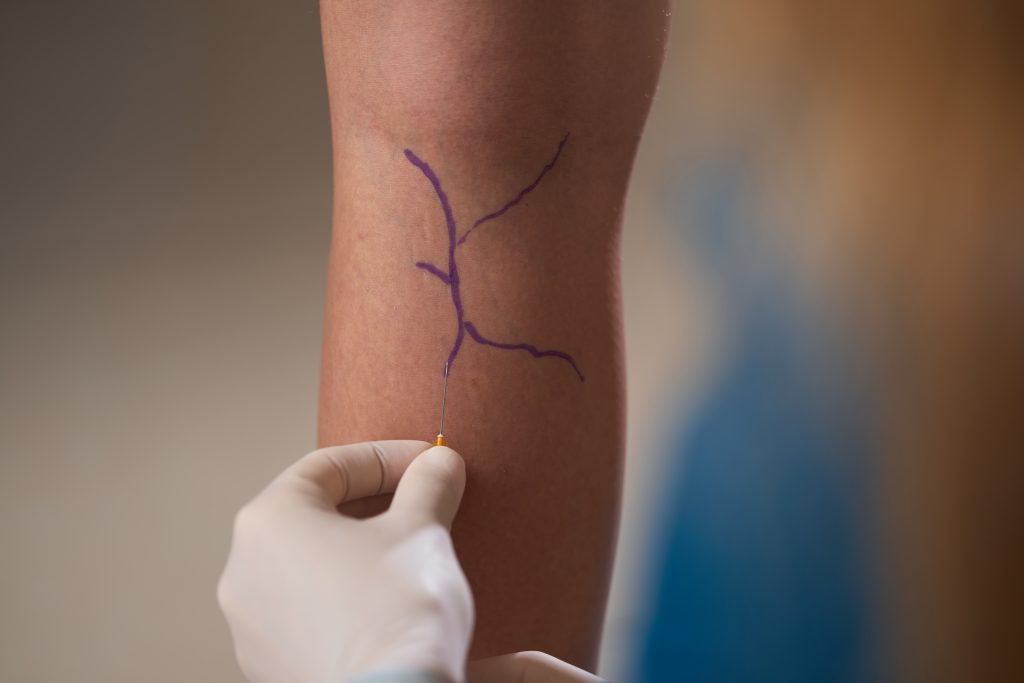Step-by-step preparation guide for genicular artery embolization procedure at Surgical Associates